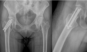 A 74-year-old woman with a non-displaced right hip fracture, fixed with cannulated screws (CS) in an inverted triangle arrangement.