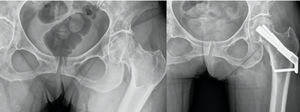 Fixation of displaced fracture of left femoral neck with FNS Synthes system. Adequate healing at 3 months post surgery.