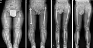 Example of a patient with achondroplasia from the series showing sequential radiographs during the femur and tibia lengthening procedure using two-stage telescopic intramedullary nails, resulting in a total height increase of 20cm.