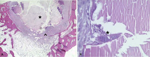 Hematoxilina-eosina. A) 4×. Biomaterial remanente (*) y tejido inflamatorio alrededor del mismo (^). B) 40×. Osteoblastos (*) en la periferia del biomaterial.
