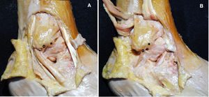 Detalle anatómico del complejo ligamentoso lateral del tobillo. El LPAA está señalado con * y el LPC está señalado como°. A. Tendones peroneos normoposicionados. B. Los tendones peroneos se han eliminado; nótese como el LPC discurre en una posición mas vertical e interviene en la estabilidad de la articulación tibioastragalina y subastragalina.