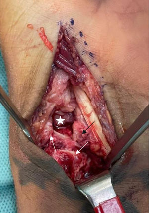 Abordaje volar extendido mostrando lesión capsulo-ligamentosa volar severa con exposición de la articulación radiocarpiana.