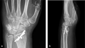 a-b)Inestabilidad carpiana residual tras tratamiento quirúrgico mostrando patrón en VISI y severa subluxación ulnar del carpo.
