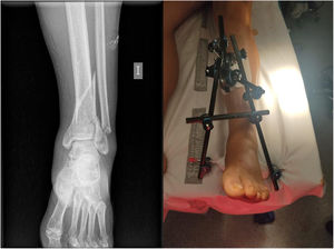 Distal third fracture of the left tibia open type II Gustilo and Anderson. Damage control surgery using closed reduction and external fixation.