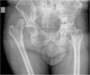 Posterior dislocation of the native hip 48h of evolution.