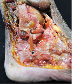 Detail of the double CFL and ATFL graft. The common tunnel in the fibula is created over the common anatomical insertion footprint of both ligaments.