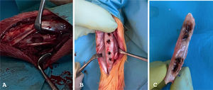 (A) Subtraction osteotomy. (B and C) Case limb bone after plate removal.