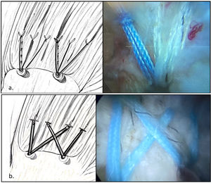 (a) Illustration and arthroscopic image of single-row repair. (b) Arthroscopic illustration and image of the repair using a double row technique.