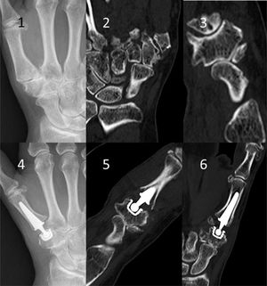 Imágenes 1, 2 y 3: radiografía preintervención y TC de una rizartrosis gradoIV. Imágenes 4, 5 y 6: radiografía de prótesis de cúpula roscada Isis® y TC de control. El paciente no presentaba dolor en la articulación ETT.