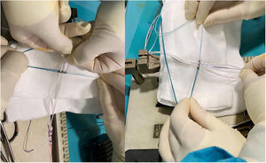 Autoinjerto de LCA de IQT cuadruplicado preparado con el sistema de fijación suspensoria. Los 2 extremos de la cinta de sutura se pasan a través de los orificios del botón femoral, de proximal a distal, de modo que ambos extremos de la sutura se dirijan distalmente acompañando al injerto, actuando como un «cinturón de seguridad».