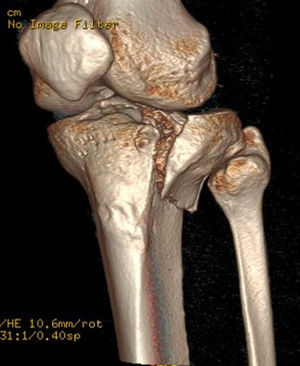 External tibial plateau fracture AO 41B3.