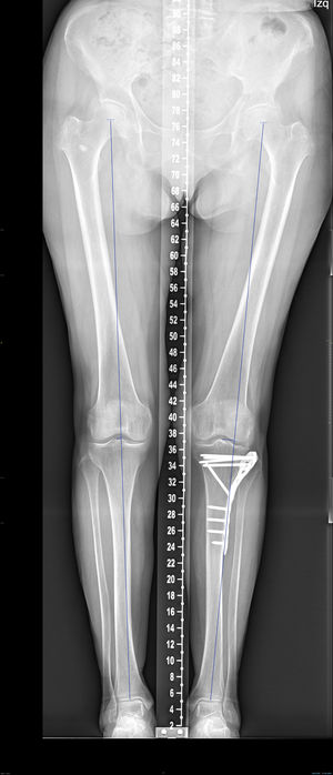 Telemetry. Note residual valgus.