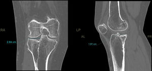 Residual joint depression (step) in coronal and sagittal CT slices.