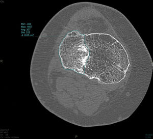 Axial CT slice, area or residual joint depression.