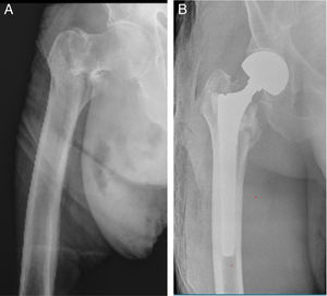 A) Fractura extracapsular de cadera tipo 2 en la clasificación de Boyd y Griffin en un paciente de 86 años. B) Evolución a un año posquirúrgico con vástago femoral no cementado de fijación diafisaria.