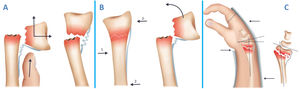 La posición de inmovilización más aceptada para FRD con desviación dorsal es con la muñeca a 15° de flexión y 10° de desviación cubital. Esta ligera desviación volar y cubital generada en la maniobra de reducción provoca que el puente de periostio dorsal intacto se tense y estabilice la fractura utilizando el principio de la banda de tensión (A, B). Concepto de apoyo en tres puntos de Charnley para estabilizar la fractura (C).