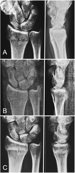 Tratamiento conservador realizado en casos de fractura del radio distal con desplazamiento mínimo, con menos de dos milímetros de acortamiento del radio y menos de 5° de inclinación dorsal. La muñeca se inmovilizó durante cuatro semanas con una férula de yeso, dejando el codo libre. Radiografías el día de la lesión (A), a los 30 días (B) y a los seis meses (C). Modificado de Fernandez DL.11.