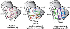 Descriptive statistics of osteochondral lesions and their location according to Raikin