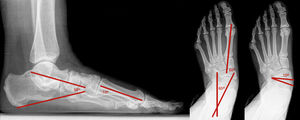 Radiografías con carga de peso para medir en AP y lateral el ángulo talar-primer metatarsiano (AP T-M1 y LAT T-M1), el ángulo talo-calcáneo en AP y lateral (AP TC y LAT TC) y la cobertura talo-navicular (TNC) en AP.