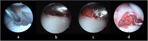 Twenty-five-year-old male operated six months after a fracture of the scaphoid waist. Left non-dominant hand. The focus is debrided with a synoviotome and a motorized burr (a). The graft is introduced into an arthroscopy sheath (4mm) (b). The graft is compressed and deposited by penetrating the obturator into the sheath (c). Exposed bone graft at the focus (d).