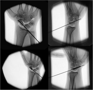 A 37-year-old male operated on 9 months after a scaphoid fracture. Dominant right hand. Placement of the cannulated screw through its guide wire. Although insertion was performed without traction and with the wrist in flexion, traction was briefly reapplied to document the position under fluoroscopy, explaining the radiocarpal and midcarpal distraction visible in the image.