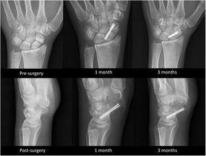 Twenty-five-year-old male operated on 6 months after a fracture of the scaphoid waist. Non-dominant left hand. AP and lateral projections showing the evolution of pseudoarthrosis consolidation at one month and three months post-surgery.