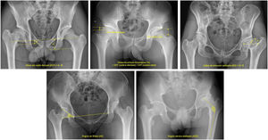 Parámetros radiológicos analizados en la última radiografía disponible. La altura del cuello femoral (ACF) se midió como la diferencia entre la distancia de la lágrima acetabular y el trocánter menor en ambas caderas; la distancia artículo-trocantérea (DAT) se calculó como la distancia entre la superficie superior de la cabeza femoral y la punta del trocánter mayor, expresándose como un porcentaje respecto a la cadera sana; el índice de extrusión epifisaria (IEE) se midió el porcentaje de descobertura acetabular respecto a la horizontal; el ángulo de Sharp (AS) corresponde a la inclinación acetabular respecto a la horizontal; y el ángulo cérvico-diafisario (ACD) midió el grado de coxa vara residual del fémur proximal.