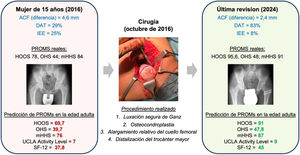Ejemplo de predicción de los PROMs en la edad adulta. Mujer de 15 años con secuelas de ELCP en la cadera derecha intervenida en nuestro centro (año 2016) de osteocondroplastia de la cabeza femoral, alargamiento relativo del cuello femoral y distalización del trocánter mayor. Tras 8 años de seguimiento (año 2024), no solo ha mejorado la situación preoperatoria (puntuaciones reales), sino que también el resultado previsto en la edad adulta (después de aplicar nuestro modelo de predicción).