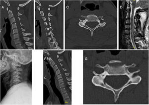 Caso clínico (M.B.): varón de 22 años con fractura facetaria derecha F3 en C5. A) Vista sagital de TC cervical sin evidencia de listesis cervical. B) Vista sagital de TC cervical que muestra fractura F3 en C5. (C) Vista axial de TC cervical que muestra masa lateral flotante. D) Evidencia de disco sano de C4–C5 en la vista sagital de IRM (T2). E) Radiografía de control a las seis semanas que muestra ausencia de evidencia de listesis. F y G) Seguimiento de TC cervical a los tres meses que muestra consolidación avanzada.