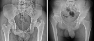 Sequelae of LCPD upon reaching skeletal maturity. The X-ray on the left shows the hips of an 18-year-old male who suffered bilateral LCPD in childhood: the right hip has adequate sphericity and congruency (Stulberg class II), while the left hip has a deformity with severe ovalisation and joint incongruence (Stulberg class V), but without degenerative changes. The X-ray on the right shows the hips of a 40-year-old male who suffered from LCPD in the right hip during childhood, currently presenting a Stulberg class IV deformity (flattening of the head and short neck) and greater trochanteric overgrowth, in addition to grade 3 Tönnis hip osteoarthritis.