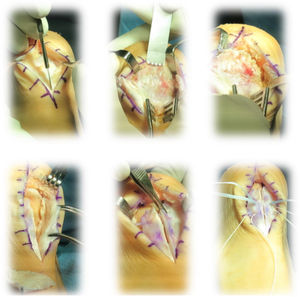 Visual summary of the surgical technique (from left to right and top to bottom). (1) Dorsal incision over the Achilles tendon. (2 and 3) Debridement and calcaneoplasty with an oscillating saw. (4–6) Double-row reattachment with harpoons.