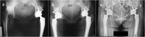 a) Radiografía postoperatoria a los 6 meses de cadera izquierda e inicial de cadera derecha. b) Radiografía postoperatoria inmediata de cadera derecha. c) Radiografía postoperatoria, 11 años de evolución.