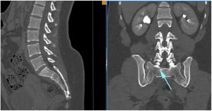 Proyecciones de tomografía de una fractura de sacro Isler III. Obsérvese la flecha señalando el trazo de fractura medial a la faceta articular superior de S1, que caracteriza este tipo de fractura.