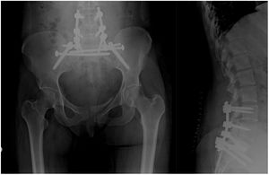 Proyecciones anteroposterior y lateral de columna lumbosacra de radiología simple. Controles postoperatorios de osteosíntesis triangular en paciente precipitada con fractura en «lambda» de sacro.