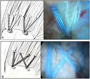 a)Ilustración e imagen artroscópica de la reparación mediante hilera simple. b)Ilustración e imagen artroscópica de la reparación mediante doble hilera.