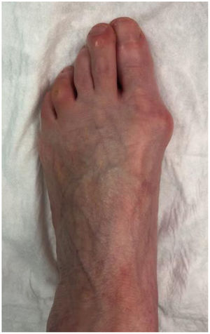 Fotografía preoperatoria de paciente intervenido de cirugía de hallux valgus realizada a 50cm de distancia del pie en la misma orientación que una radiografía anteroposterior.
