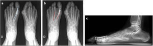 a y b) Radiografía dorsoplantar en carga postoperatoria. Ángulo del hallux (azul) y ángulo intermetatarsal (rojo). c) Radiografía lateral en carga postoperatoria. Ángulo metatarsofalángico dorsal del primer dedo (negro).