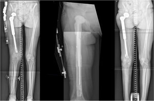 Customized hip cement mega-spacer for a hip megaprosthesis septic two-stage revision surgery after proximal femur chondrosarcoma (preoperative, 1st stage, and 2nd stage).