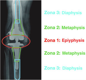 Fixation by knee revision surgery areas. Source: Morgan-Jones et al.2