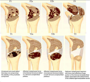 Anderson Orthopedic Research Institute (AORI) classification of bone defects. Source: Engh and Ammeen.4