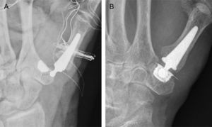 (A) Dislocated Touch® prosthesis in the immediate postoperative period; showing a proximal articular surface of the trapezium (PAST) angle greater than 16°, the implant was placed without the aid of fluoroscopy. (B) Isis® prosthesis placed with the aid of fluoroscopy and reaming guide wire; a PAST angle close to 0°can be measured.