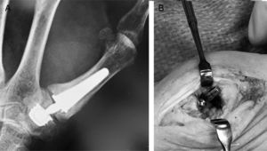 (A) Extrusion of the neck of the Isis® prosthesis due to calcification of the trapezium. (B) Intraoperative disimpaction of the neck is observed.