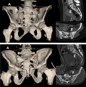 Anatomical criteria for sacral dysmorphism. CT images of a pelvis that meets all the anatomical criteria for sacral dysmorphism (top) and one that meets none (bottom) are shown: (A) Collinearity of the S1 platform with the iliac crest. In the image below, the platform is clearly inferior to the iliac crests. (B) Mammillary tubercles. (C) Acute sacral slope. In the image below, the slope is reversed. (D) Non-spherical and irregular S1 foramen. (E) Persistence of residual intervertebral disc between S1 and S2. (F) Tongue-in-groove sacroiliac joints. In non-dysmorphic pelvis, the profile of the sacroiliac joints in the axial section of the CT scan is regular.