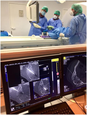 Multidisciplinary collaboration in the insertion of iliosacral screws with CT. On the left, the 2 surgeons perform the procedure. On the right, the interventional musculoskeletal radiologist controls the CT scan. The radiology technician collaborates in the control of the apparatus and the generation of images of clinical interest during the procedure.