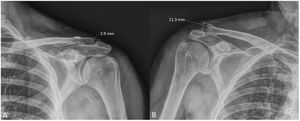Measurement in millimetres (mm) of the distance from the upper edge of the acromion to the upper edge of the distal end of the clavicle. (A) Patient undergoing surgical treatment (2.9mm). (B) Patient managed conservatively (11.3mm).