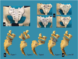 Schematic of different classifications of sacral fractures. Denis's classification (a), Roy Camille classification, modified by Strange-Vognsen and Lebech (b), morphological classification of fractures, into “H”, “U”, “T” and “Lambda” (c) and caudal sacral fractures (d).