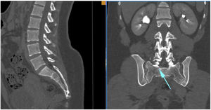 CT views of an Isler III sacral fracture. Note the arrow pointing to the fracture trace medial to the superior articular facet of S1, which characterises this type of fracture.