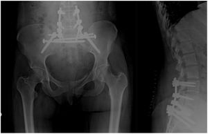Anteroposterior and lateral views of lumbosacral spine from plain X-ray. Postoperative controls of triangular osteosynthesis in a patient after a fall with a lambda fracture of the sacrum.