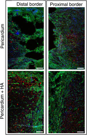 Fluorescence images using a 10× objective on a confocal microscope, centred on the distal and proximal borders of the lesion, taken from tissue sections processed for PDGFRβ (green) and NF (red). Hoechst-stained blue nuclei are shown. A dense fibrotic scar positive for PDGFRβ was observed that prevented axonal growth (red). The scar was denser and more impenetrable to axons when hyaluronic acid was applied to the lesion. Scale bar, .2mm.
