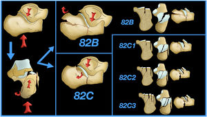 Clasificación AO de las fracturas de calcáneo: se detallan las principales fuerzas deformantes y los principales fragmentos.